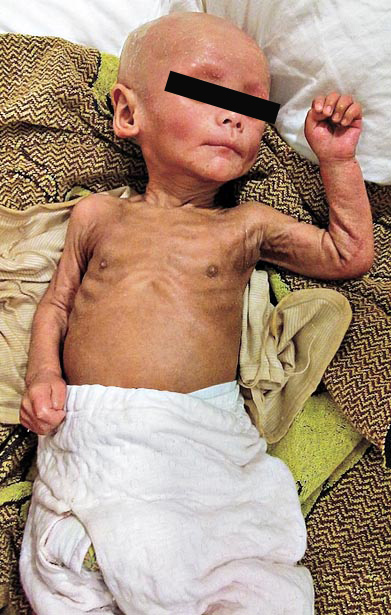  สลด ทารกจีนเสียชีวิต หลังฉีดวัคซีนป้องกันวัณโรค