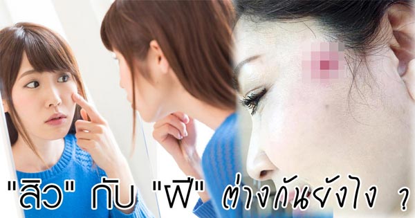สิวกับฝีต่างกันอย่างไร สิวกับฝีต่างกันอย่างไร