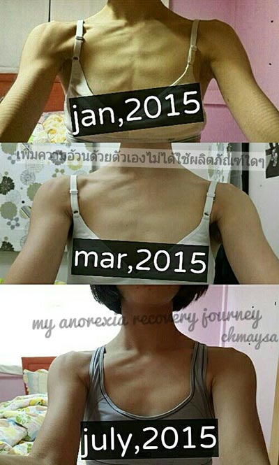 โรคอะนอเร็กเซีย โรคอะนอเร็กเซีย
