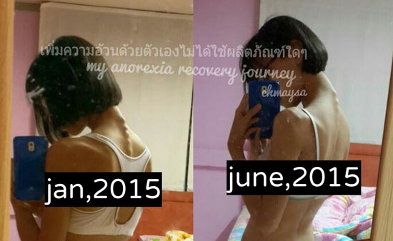 โรคอะนอเร็กเซีย โรคอะนอเร็กเซีย