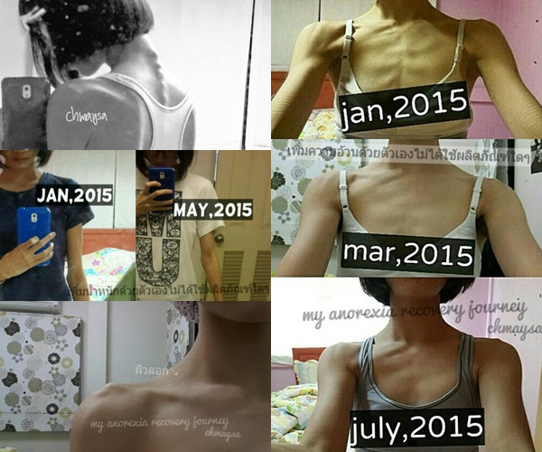 Anorexia Anorexia