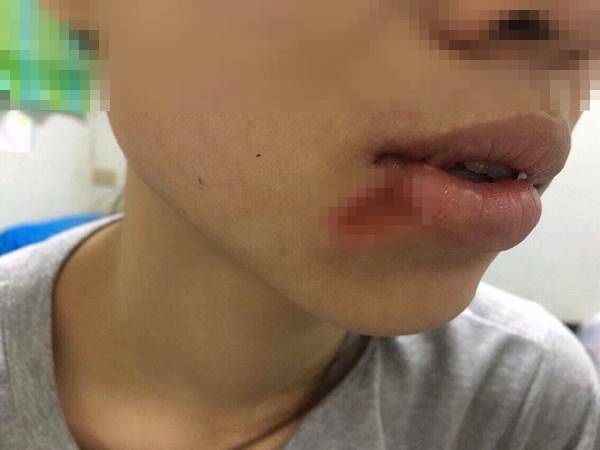 ผ่าฟันคุด ผ่าฟันคุด