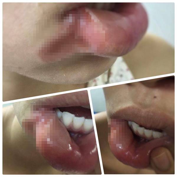 ผ่าฟันคุด ผ่าฟันคุด