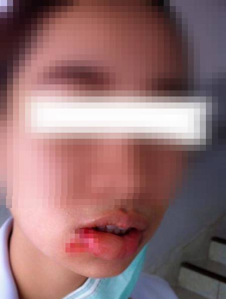 ผ่าฟันคุด ผ่าฟันคุด
