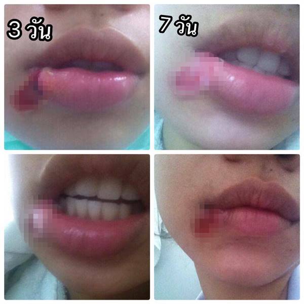 ผ่าฟันคุด ผ่าฟันคุด