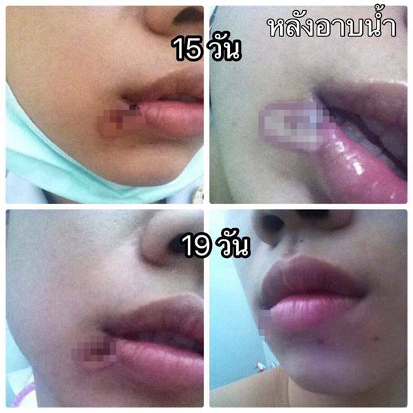 ผ่าฟันคุด ผ่าฟันคุด