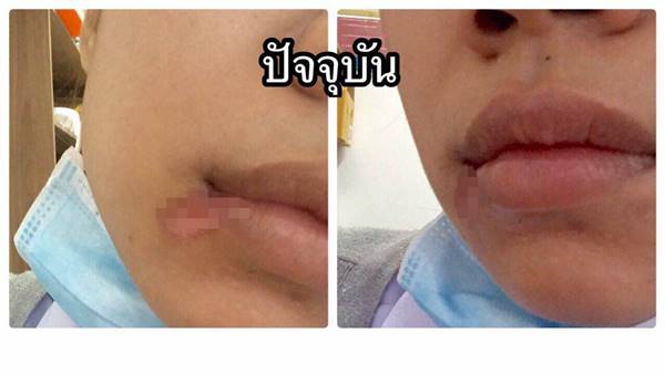 ผ่าฟันคุด ผ่าฟันคุด