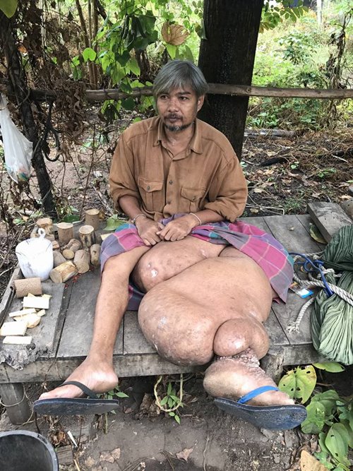 สื่อนอกเวทนา ชายไทยป่วยเรื้อรังนับ 10 ปี ขาบวมเท่าขาช้าง เจ็บทุกย่างก้าวที่เดิน