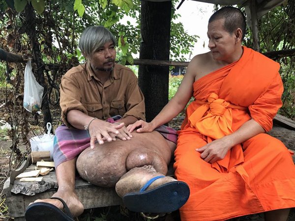 สื่อนอกเวทนา ชายไทยป่วยเรื้อรังนับ 10 ปี ขาบวมเท่าขาช้าง เจ็บทุกย่างก้าวที่เดิน สื่อนอกเวทนา ชายไทยป่วยเรื้อรังนับ 10 ปี ขาบวมเท่าขาช้าง เจ็บทุกย่างก้าวที่เดิน