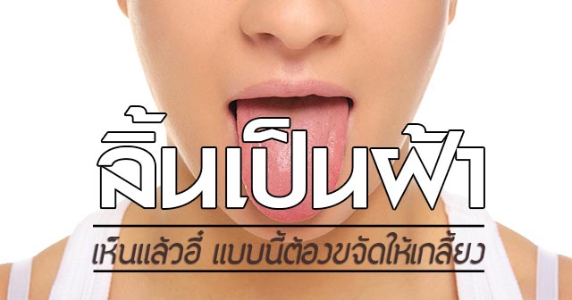 ลิ้นเป็นฝ้าขาว ลิ้นเป็นฝ้าขาว