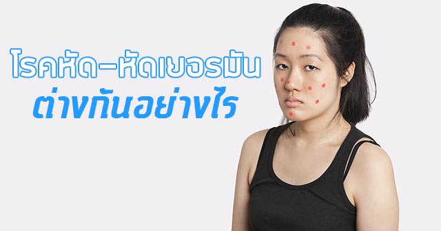 โรคหัด โรคหัด