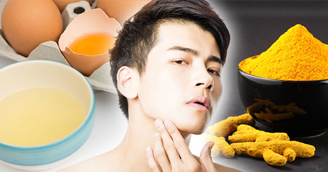 วิธีรักษาสิวแบบธรรมชาติ วิธีรักษาสิวแบบธรรมชาติ