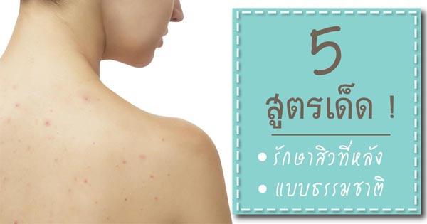 รักษาสิวที่หลังแบบธรรมชาติ รักษาสิวที่หลังแบบธรรมชาติ