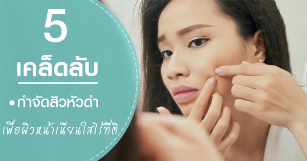 วิธีกำจัดสิวหัวดำ วิธีกำจัดสิวหัวดำ