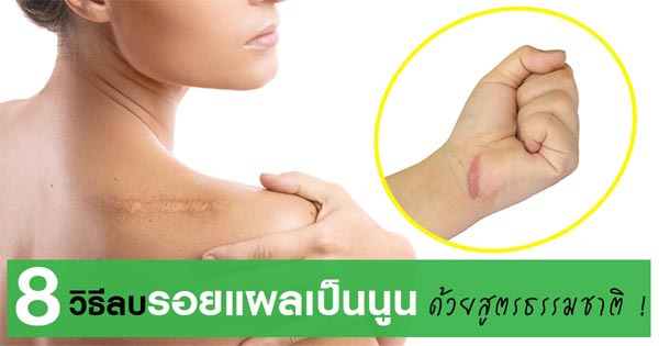 วิธีลบรอยแผลเป็นนูน วิธีลบรอยแผลเป็นนูน