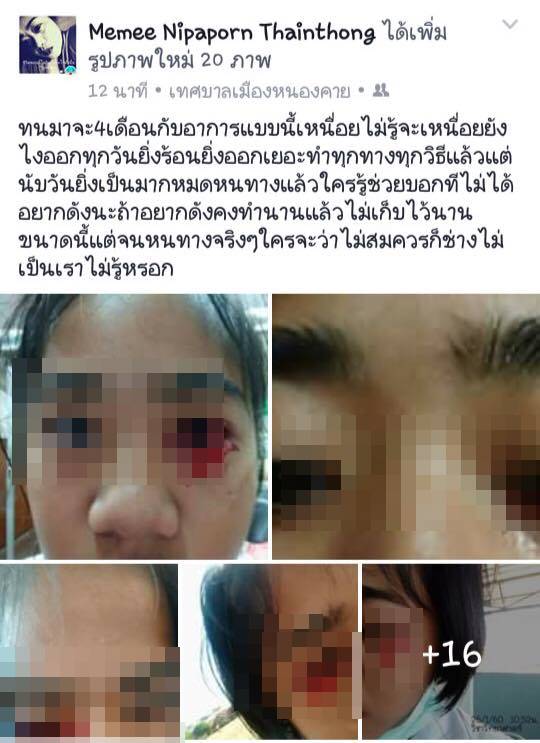 เหงื่อออกเป็นเลือด เหงื่อออกเป็นเลือด