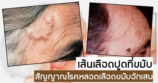 เส้นเลือดปูดที่ขมับ เส้นเลือดปูดที่ขมับ