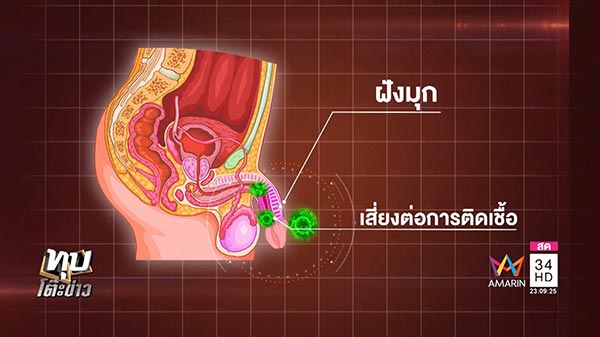 การฝังมุก การฝังมุก