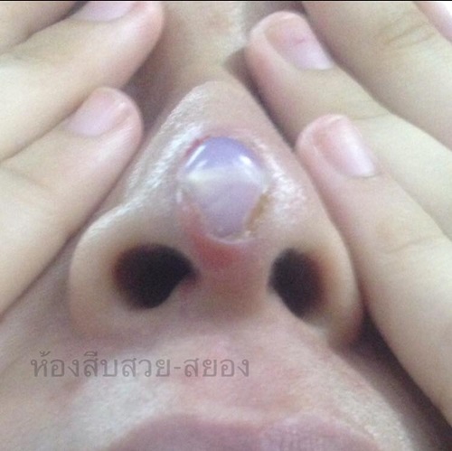 ศัลยกรรมหน้าพัง ศัลยกรรมหน้าพัง