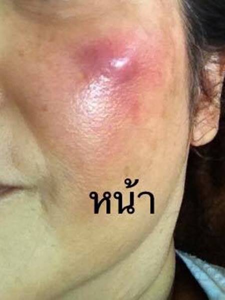 อย่าล้างแผลที่ก๊อกน้ำหรือฝักบัว อย่าล้างแผลที่ก๊อกน้ำหรือฝักบัว