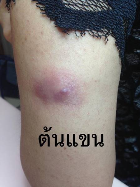 อย่าล้างแผลที่ก๊อกน้ำหรือฝักบัว อย่าล้างแผลที่ก๊อกน้ำหรือฝักบัว