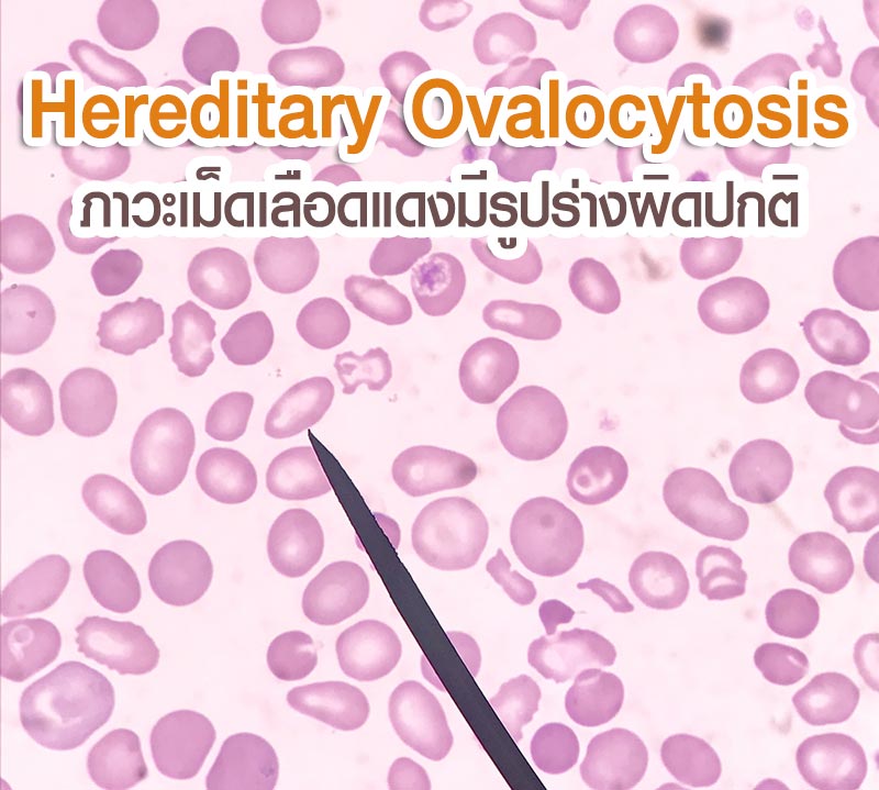 โรค Hereditary Ovalocytosis