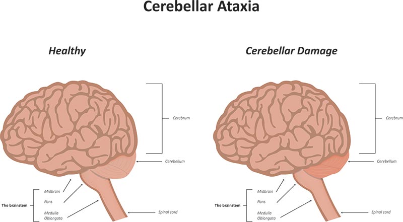 โรค ataxia โรค ataxia