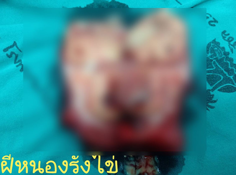 หนองในรังไข่ หนองในรังไข่