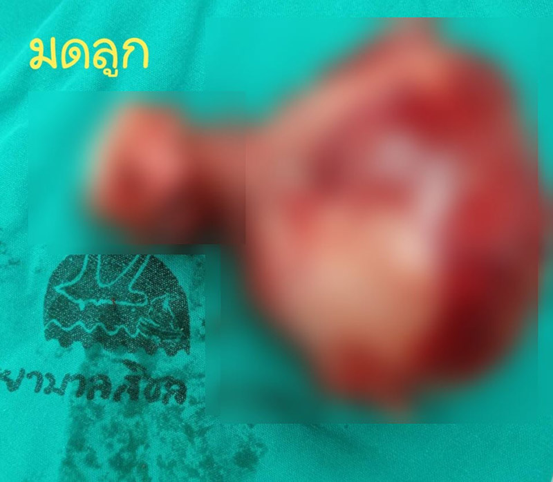 หนองในรังไข่ หนองในรังไข่
