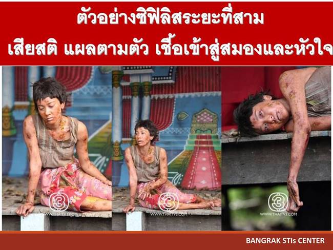 โรคซิฟิลิส โรคซิฟิลิส