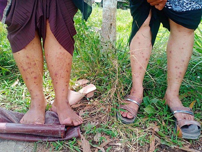 โรคหอยคัน ระบาดหนัก โรคหอยคัน ระบาดหนัก