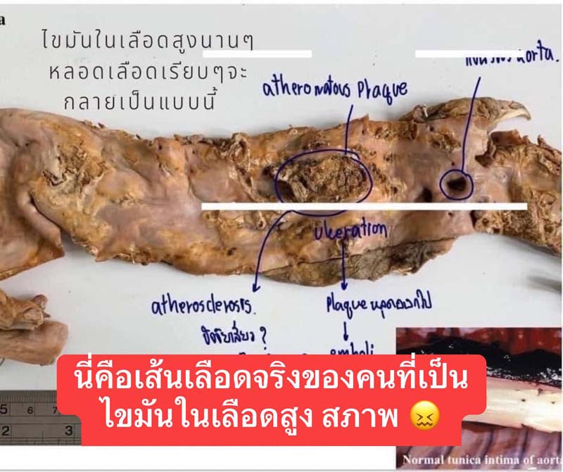 ไขมันในเลือดสูง ไขมันในเลือดสูง