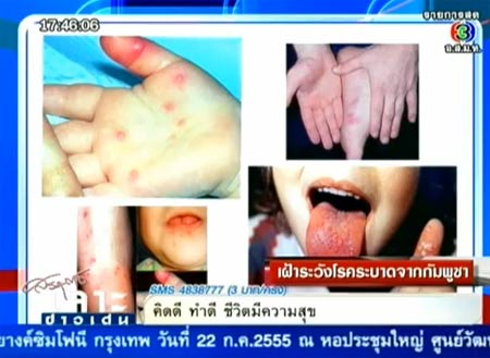 โรคมือเท้าปาก กัมพูชา  สธ. ยัน ไม่อันตราย