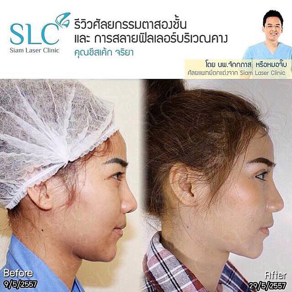 ชีสเค้ก จริยา พริตตี้ศัลยกรรม ชีสเค้ก จริยา พริตตี้ศัลยกรรม