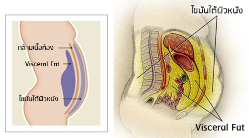 ภาวะไขมันในช่องท้อง