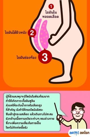 ภาวะไขมันในช่องท้อง