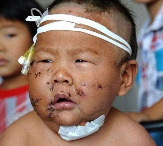 แม่จีนโหดคว้ากรรไกรแทงหน้าลูกกว่า 90 ครั้ง หลังลูกกัดหัวนม
