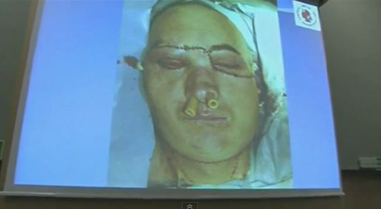 แพทย์โปแลนด์ผ่าตัดปลูกถ่ายใบหน้าผู้ป่วยสำเร็จครั้งแรกของโลก