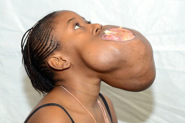 สาวคองโกเนื้องอกเต็มปาก ใหญ่เท่าลูกฟุตบอล