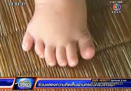 น้องเนย วัย 6 เดือน มีนิ้วมือ-นิ้วเท้า รวม 24 นิ้ว