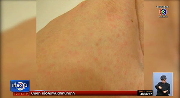 ไข้อีดำอีแดงระบาด พิจิตรพบนักเรียนป่วยแล้ว 11 ราย 