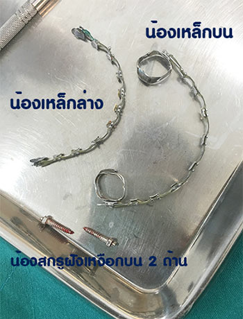 แชร์ประสบการณ์จัดฟัน