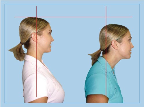 Forward head posture Forward head posture