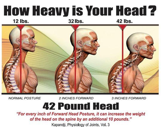 Forward head posture Forward head posture