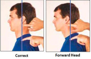 Forward head posture Forward head posture