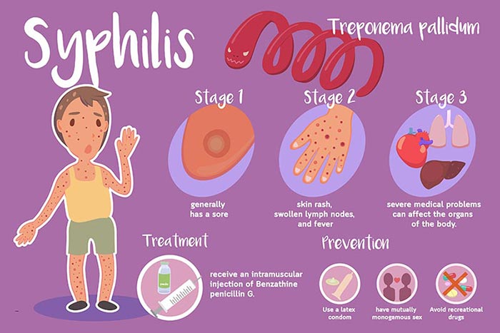 congenital syphilis guideline ไทย vs