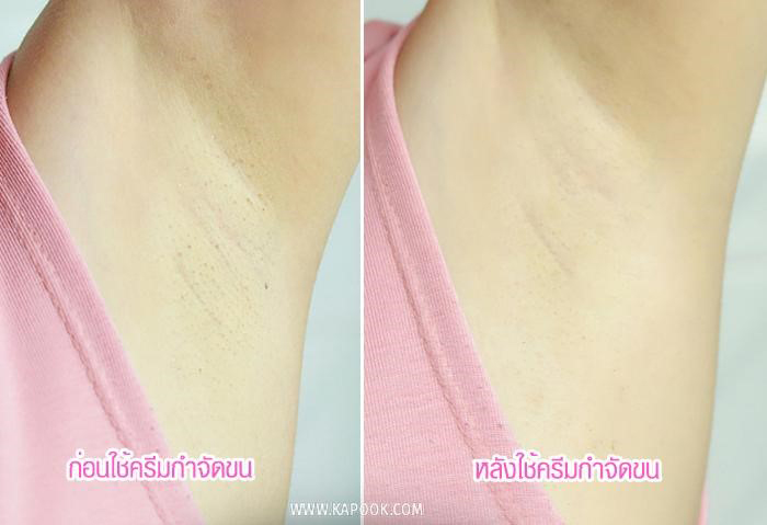 ก่อนใช้ และหลังใช้ครีมกำจัดขน veet