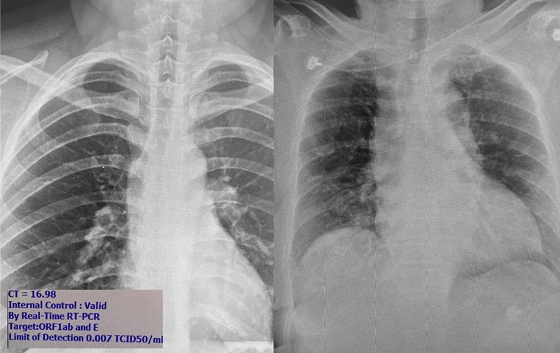 Lungs of people infected with COVID 19