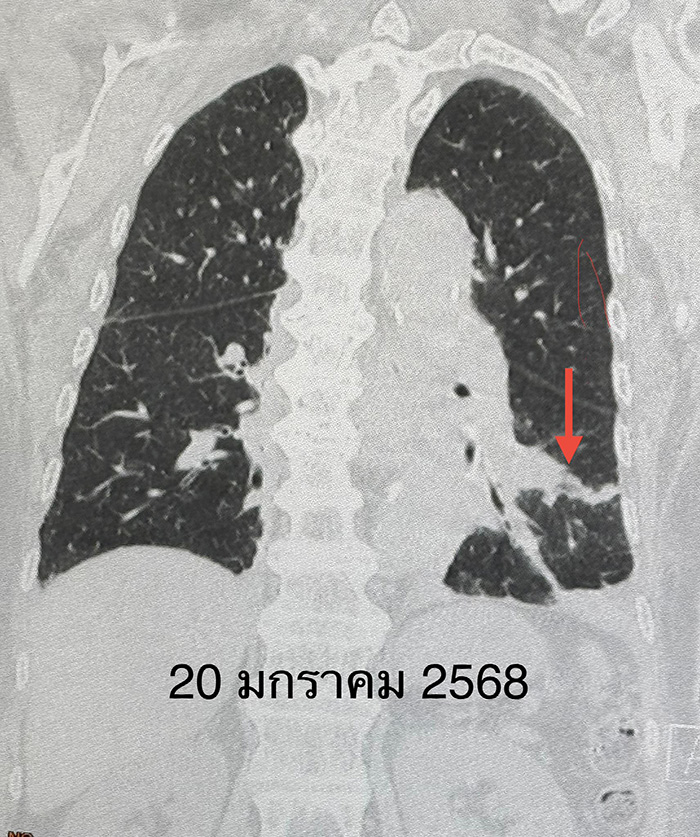 เปิดแอร์เข้าพักในคอนโด สุดท้ายปอดอักเสบ