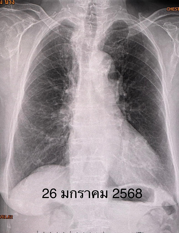 เปิดแอร์เข้าพักในคอนโด สุดท้ายปอดอักเสบ